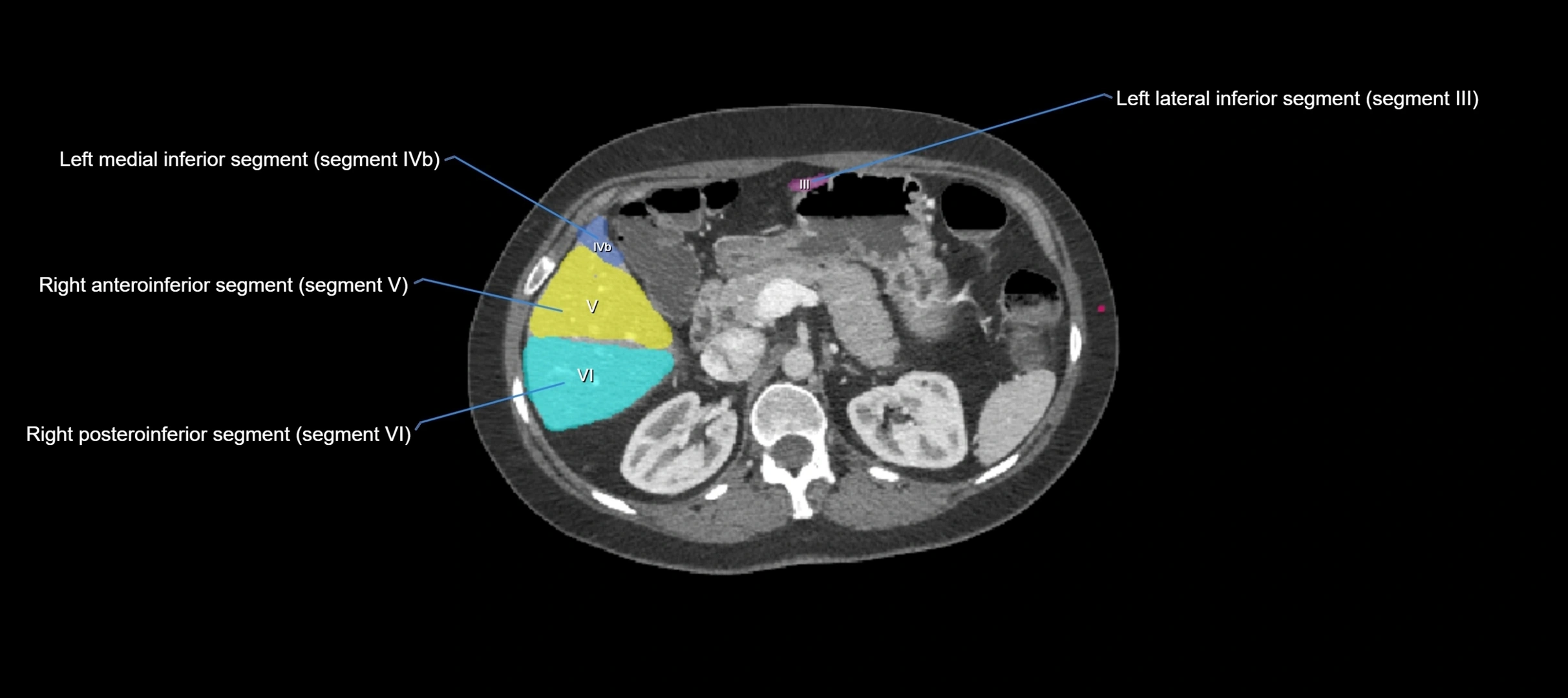 CT liver segments axial cross sectional anatomy labelled image-00033.webp